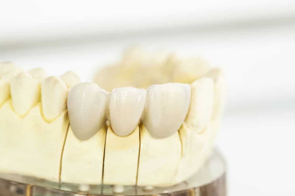 כתרים בשיניים קדמיות