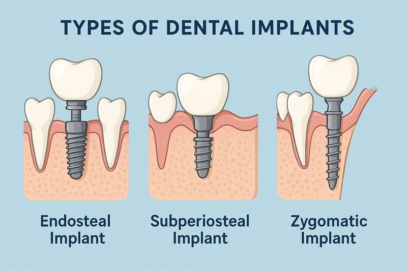 הדמיה של סוגי שתלים דנטליים סוגי שתלים דנטליים שונים